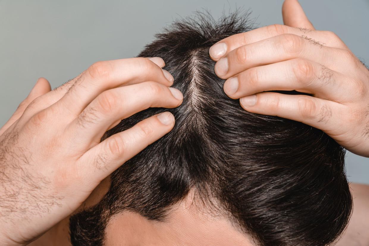 Closeup male dark hair. Head skin problems, receding hairline, alopecia, dandruff concept