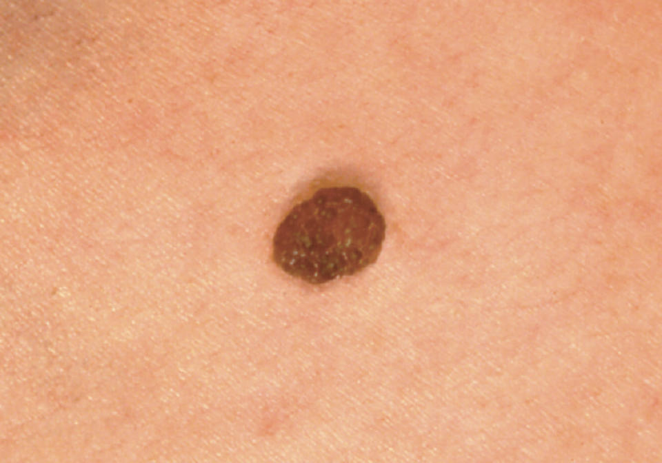 A noncancerous mole illustrating how there can be slight color variations within the mole but it's still benign. (Courtesy The Skin Cancer Foundation)