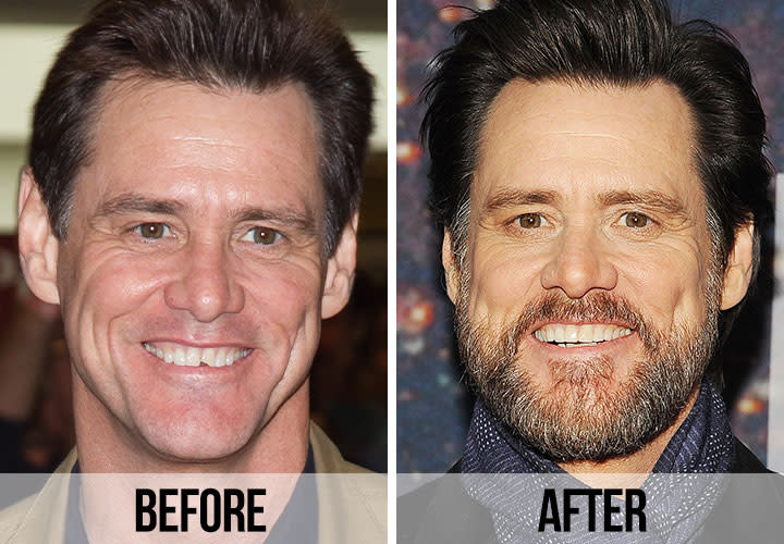 21 Celebrity Dental Implants And Veneers: Before And After