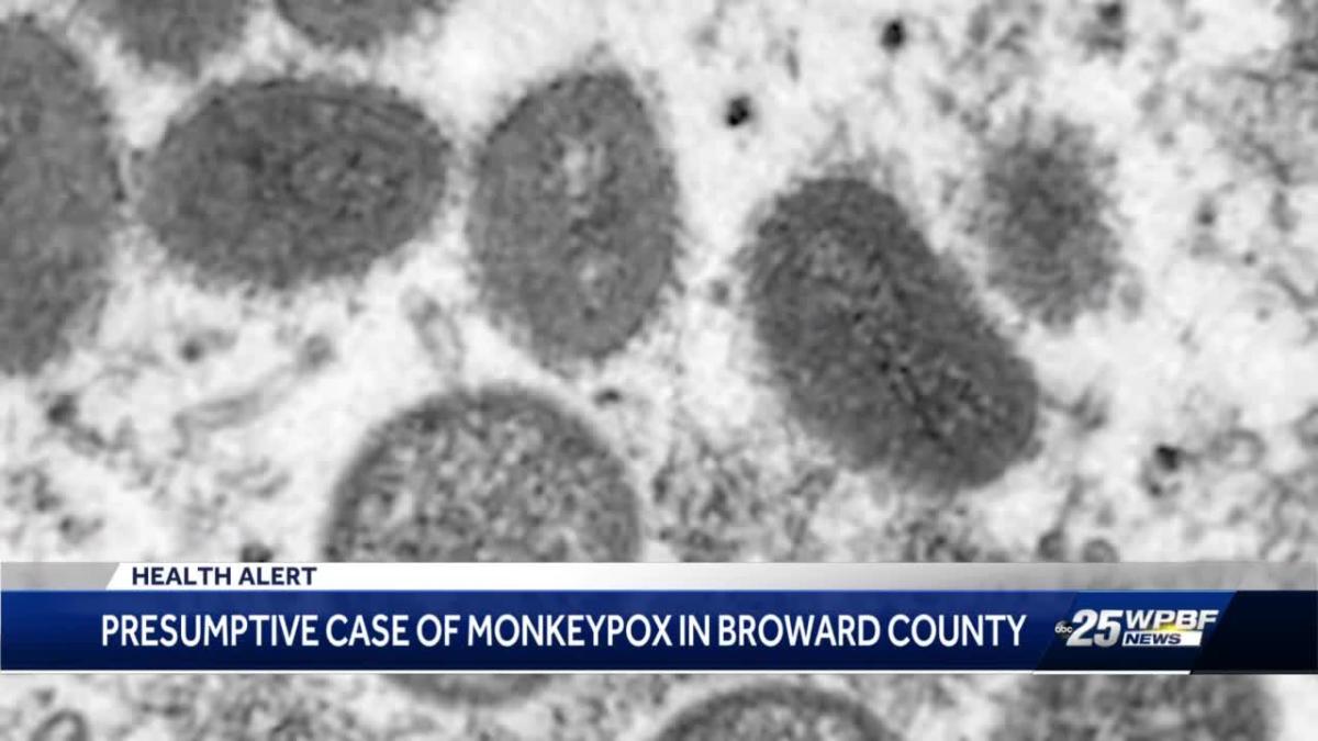 Expert weighs in on presumptive monkeypox case in South Florida