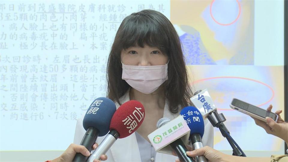 正妹「紋眉」長50顆肉芽　感染病毒疣險毀容