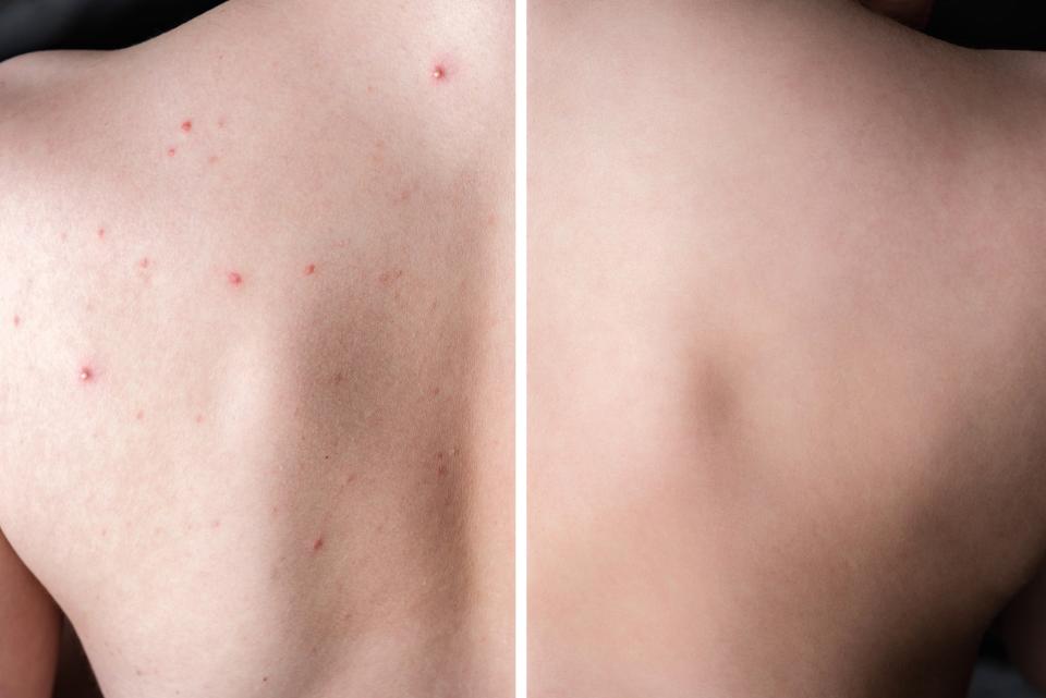 Body-Acne-Before-After-Stock-Photo
