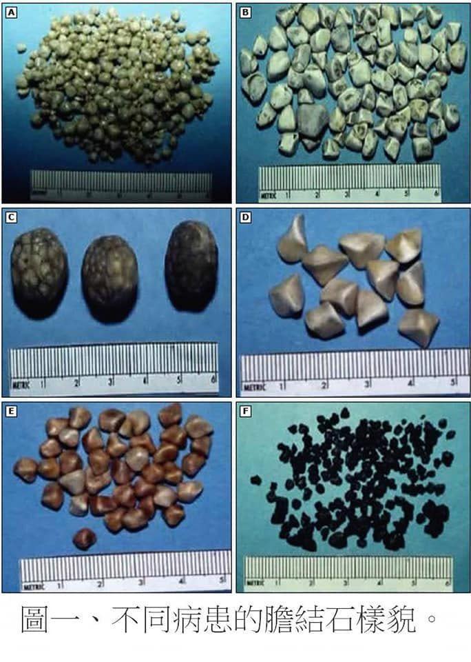 醫師杜承哲放上不同分類的結石外貌給大家參考。（翻攝國軍高雄醫院院刊）