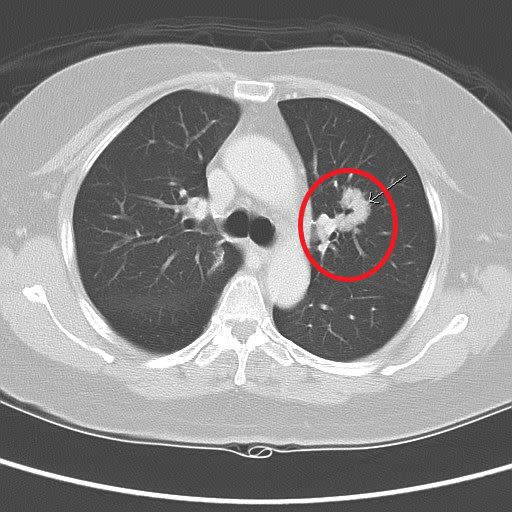 婦人的左上肺葉長了惡性腫瘤。（圖／國泰綜合醫院提供）