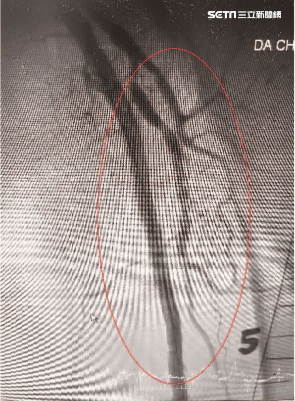 經微創導管支架手術後，成功打通血管(紅圈處)，謝奶奶的腳馬上恢復溫暖也不再疼痛。（圖／大千綜合醫院）