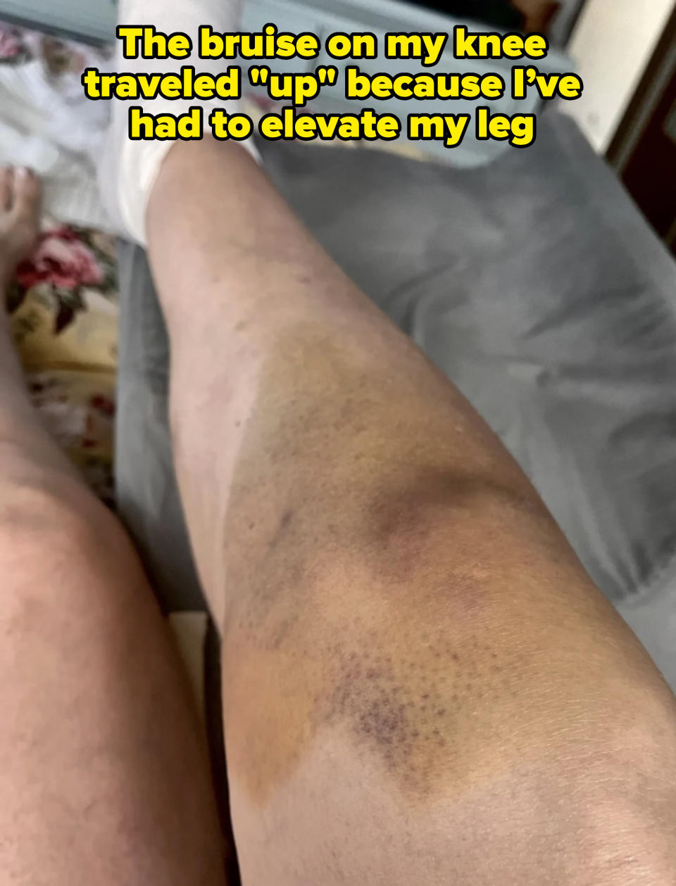 A close-up of a bruised leg resting on a soft surface. The leg has significant bruising and discoloration. No people are identified in the image