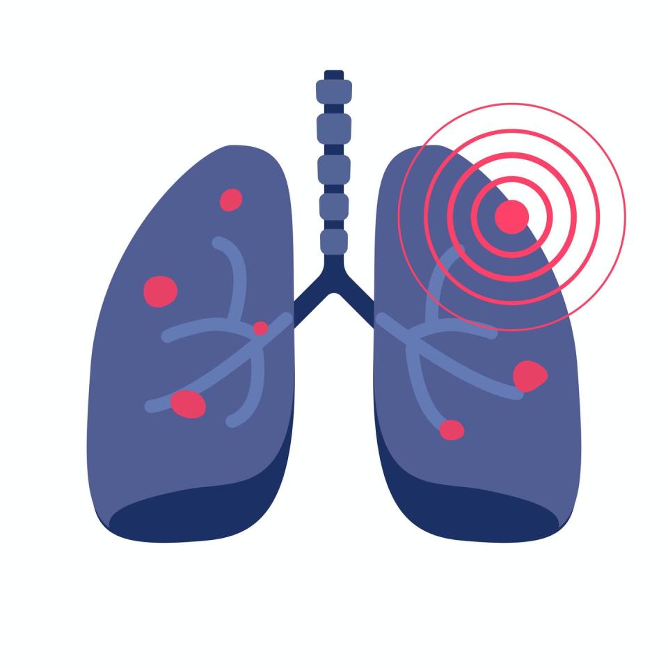 <span class="caption">Lung cancer is the No. 1 cause of cancer-related deaths worldwide.</span> <span class="attribution"><a class="link " href="https://www.gettyimages.com/detail/illustration/lungs-cancer-illness-or-lung-pneumonia-and-royalty-free-illustration/1223142317" rel="nofollow noopener" target="_blank" data-ylk="slk:vladwel/iStock via Getty Images Plus;elm:context_link;itc:0;sec:content-canvas">vladwel/iStock via Getty Images Plus</a></span>