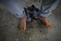 In this Aug. 31, 2018 photo, Venezuelan migrant Orlando, 44, gets medical treatment for his feet as he rests from walking across the country, outside the home of Marta Duque, who opens her doors to provide shelter for Venezuelan families with young children, in Pamplona, Colombia. Pamplona is one of the last cities migrants reach before venturing up a frigid Berlin paramo, one of the most feared parts of the journey by foot, with a high altitude and temperatures that dip to 10 degrees below freezing. (AP Photo/Ariana Cubillos)