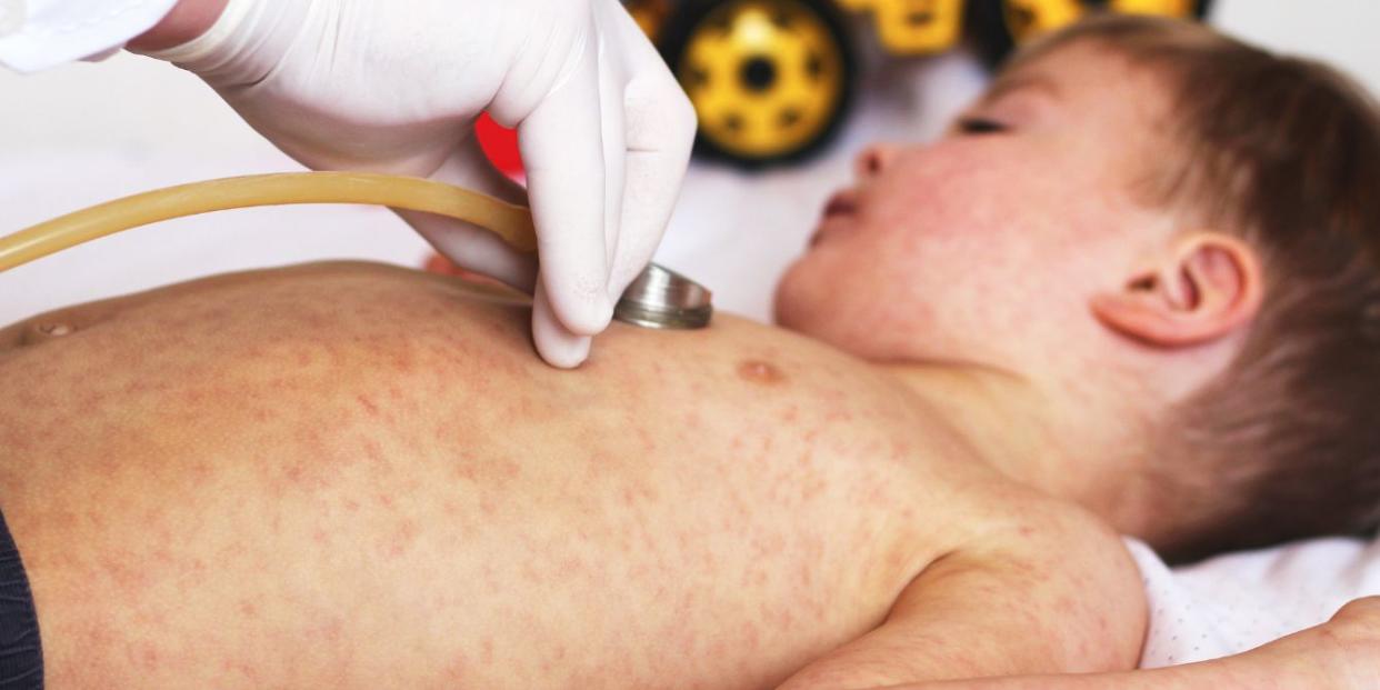 child with measles at doctor's office - measles outbreak in multiple states