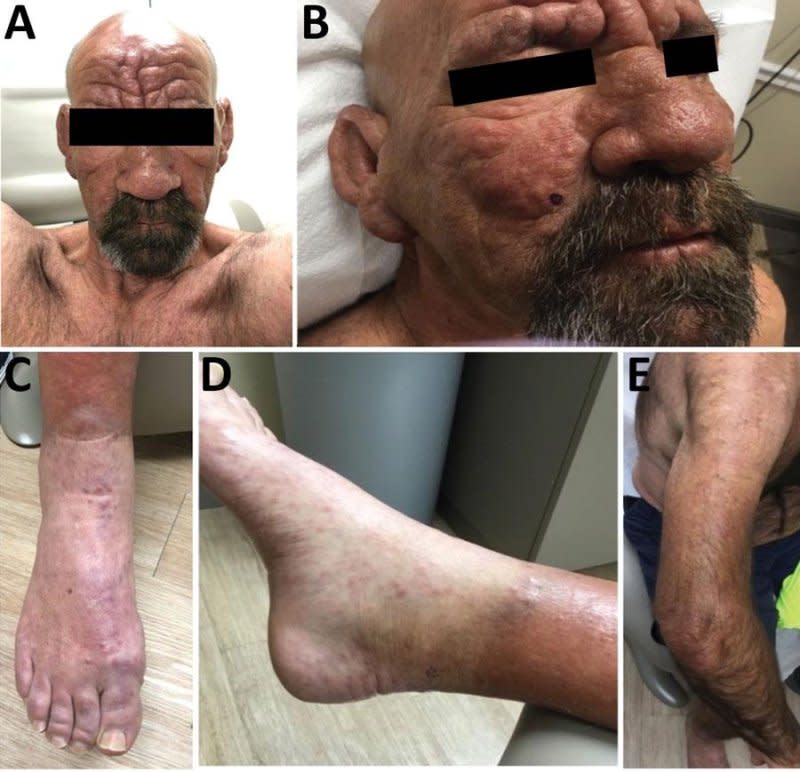 The CDC report cited a 54-year-old central Florida man who reported contracting leprosy "Without risk factors for known transmission routes." Photo courtesy of the Centers for Disease Control and Prevention.