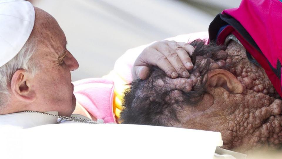 Pope Francis <a href="http://ca.news.yahoo.com/blogs/good-news/vinicio-riva-disfigured-man-blessed-pope-shares-story-183054568.html" data-ylk="slk:embraced a man;elm:context_link;itc:0;sec:content-canvas;outcm:mb_qualified_link;_E:mb_qualified_link;ct:story;" class="link  yahoo-link">embraced a man</a> with the tumorous disease neurofibromatosis at a Nov. 6 event. He paused for a few moments, kissing the man and giving him a blessing, the Catholic News Agency reported. The man, Vinicio Riva, <a href="http://ca.news.yahoo.com/blogs/good-news/touching-picture-shows-pope-francis-kissing-severely-disfigured-150849081.html" data-ylk="slk:later shared his story;elm:context_link;itc:0;sec:content-canvas;outcm:mb_qualified_link;_E:mb_qualified_link;ct:story;" class="link  yahoo-link">later shared his story</a> and said he is often shunned in public because of his condition. (ABC News screengrab)