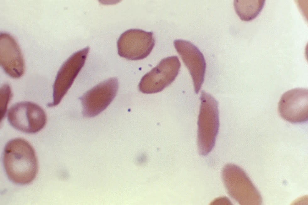 This microscope photo provided on Oct. 25, 2023, by the Centers for Disease Control and Prevention shows crescent-shaped red blood cells from a sickle cell disease patient in 1972. (Dr. F. Gilbert/CDC via AP, File )