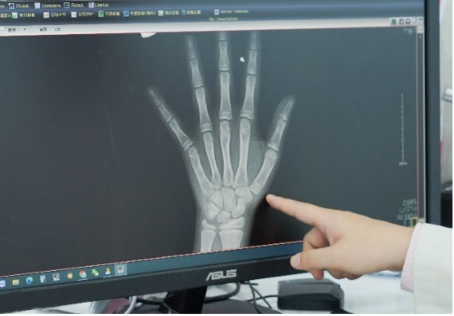 手部Ｘ光可以看到手指、手掌、手腕的生長板，需持續追蹤半年至一年以上的時間，觀察骨骼及生長板的變化，才得以讓兒童內分泌專科醫師較正確的推估骨齡、進一步作為性早熟病程的完整評估或後續治療方針。（圖／禾馨提供）