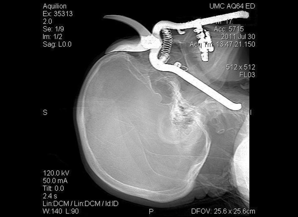 In this image provided by the University Medical Center in Tucson, a CT scan shows a pair of pruning shears embedded in the head of an 86-year-old Green Valley, Ariz., man before it was removed by Medical Center surgeons in Tucson on July 30, 2011.  Leroy Luetscher was accidentally impaled through his eye socket after falling on the shears while working in his yard, the handle penetrating his eye socket and reaching down into his neck. He is expected to make a full recovery. (AP Photo/University Medical Center,Tucson, Arizona)