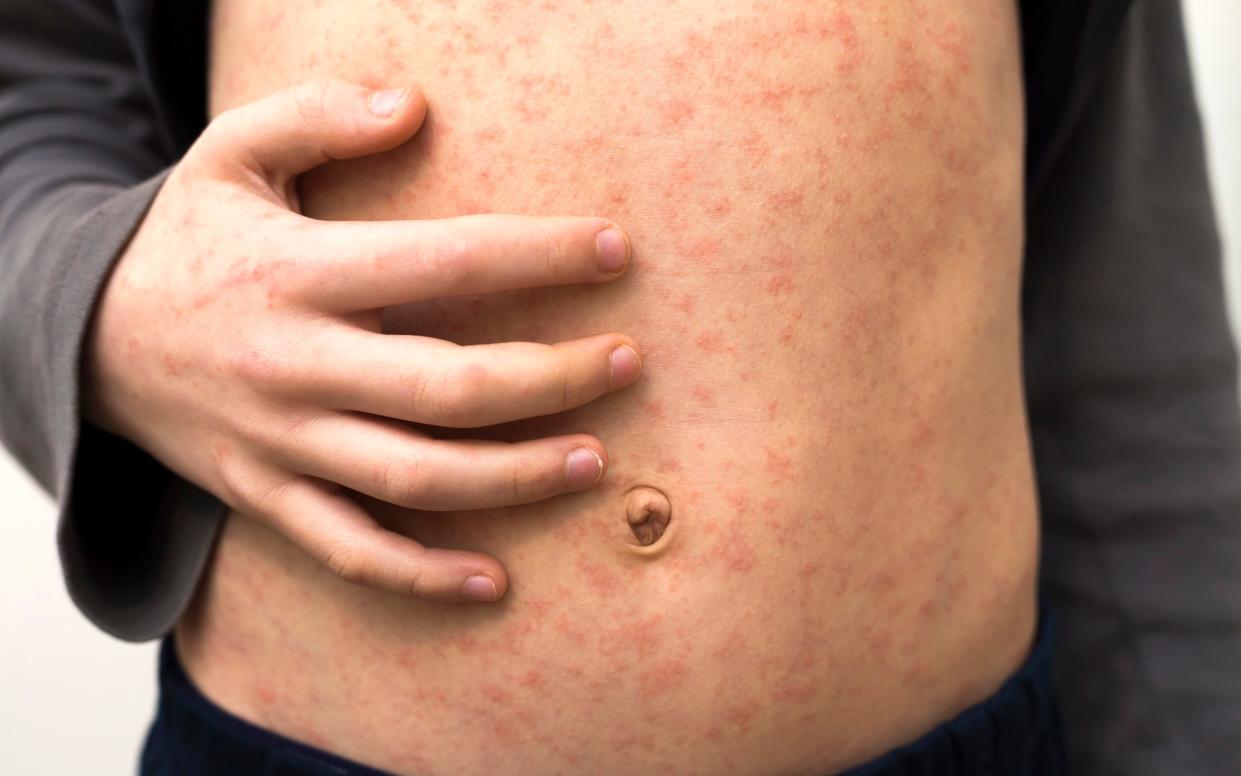 Sick child with red rash spots from measles