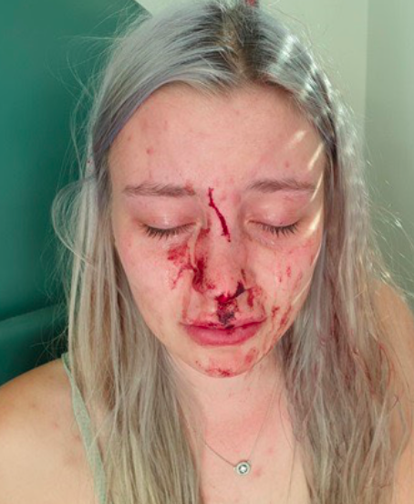 Amelia Duckworth was rushed to hospital where she received stitches for a gash between her eyes and her scalp was glued. (Solent)