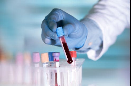 <span class="caption">Our blood test showed that in people with MS, their immune response to EBV was higher than it was in people who weren't diagnosed with the condition.</span> <span class="attribution"><a class="link " href="https://www.shutterstock.com/image-photo/hands-lab-technician-tube-blood-sample-441264445" rel="nofollow noopener" target="_blank" data-ylk="slk:angellodeco/ Shutterstock;elm:context_link;itc:0;sec:content-canvas">angellodeco/ Shutterstock</a></span>