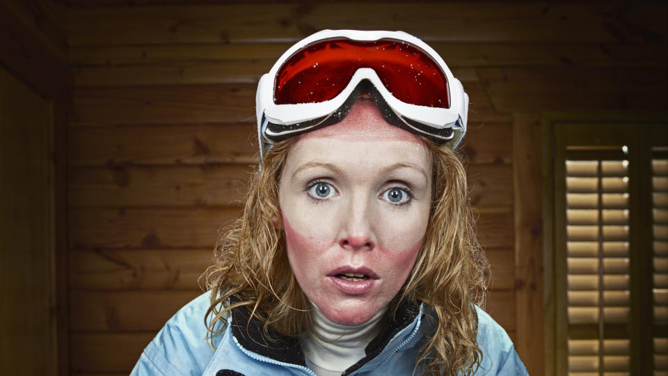 A woman with a ski goggle sunburn