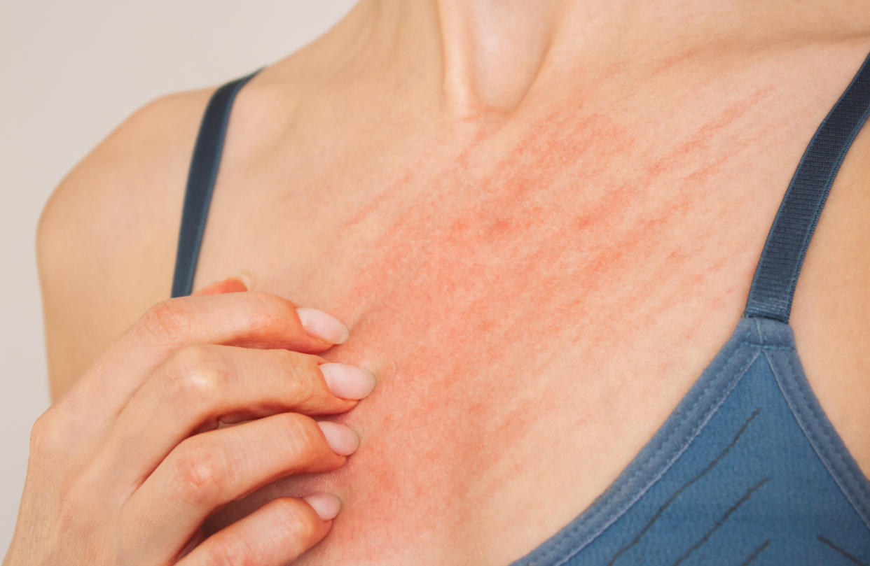 photo of a woman in blue underwear who scratches her breasts and suffers from allergies, itching, skin rash, dermatitis, scabies. Allergic reaction. Skin diseases. Healthcare concept