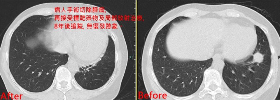 右圖為8年前病人罹患肺癌尚未接受治療的電腦斷層影像，左圖為病人接受手術切除腫瘤。（照片羅東博愛醫院提供）