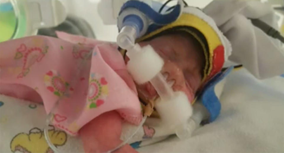 Popular superfood coconut oil saved Perth premature baby Isabella's skin.