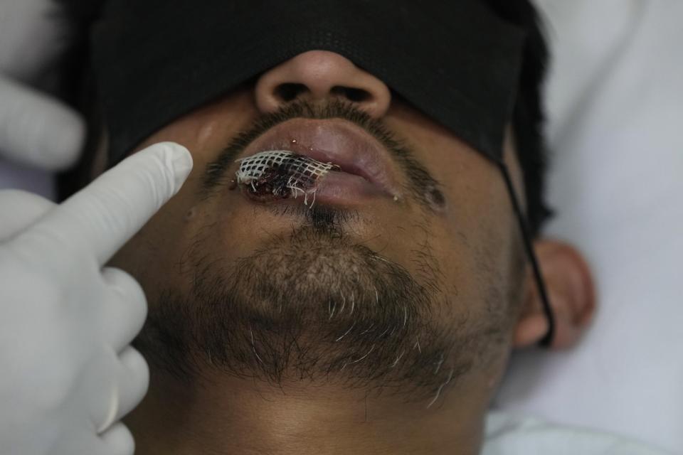 Un médico muestra una llaga causad por la viruela símica en el labio de un paciente en el hospital Arzobispo Loayza en Lima, Perú, el martes 16 de agosto de 2022. (Foto AP/Martín Mejía)