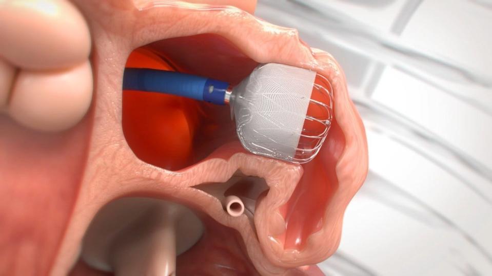 About the size of a quarter, the Watchman device, at the catheter's tip, is placed into the left atrial appendage of the heart, where 90% of stroke-causing blood clots are formed.