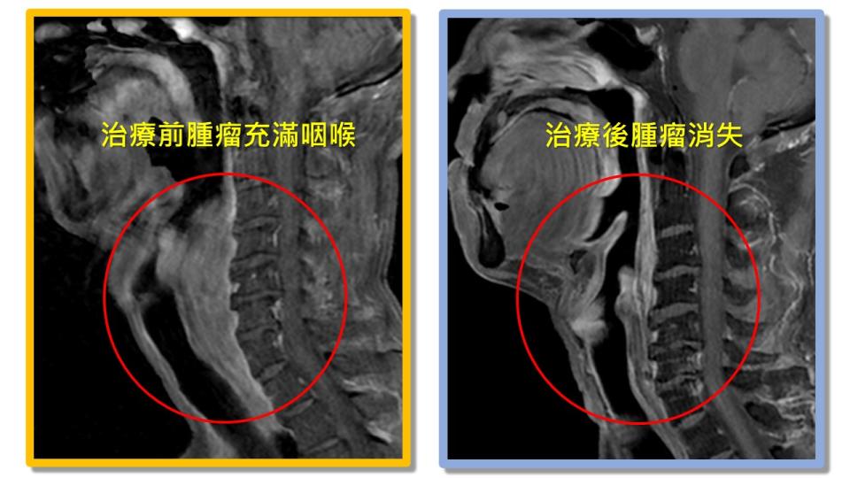 黃先生接受引導式化療後，腫瘤明顯消失。