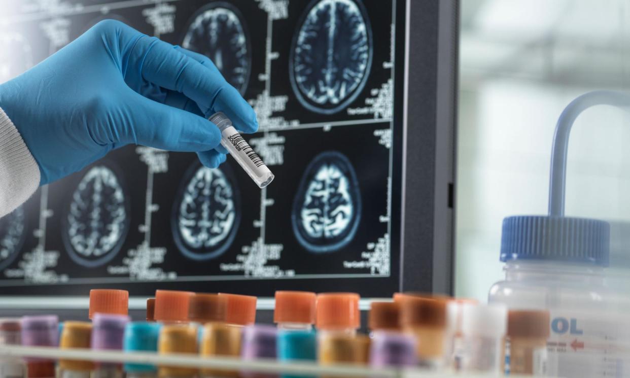 <span>Experts believe the tests could make the diagnosis of Alzheimer’s more accessible.</span><span>Photograph: Science Photo Library/Alamy</span>