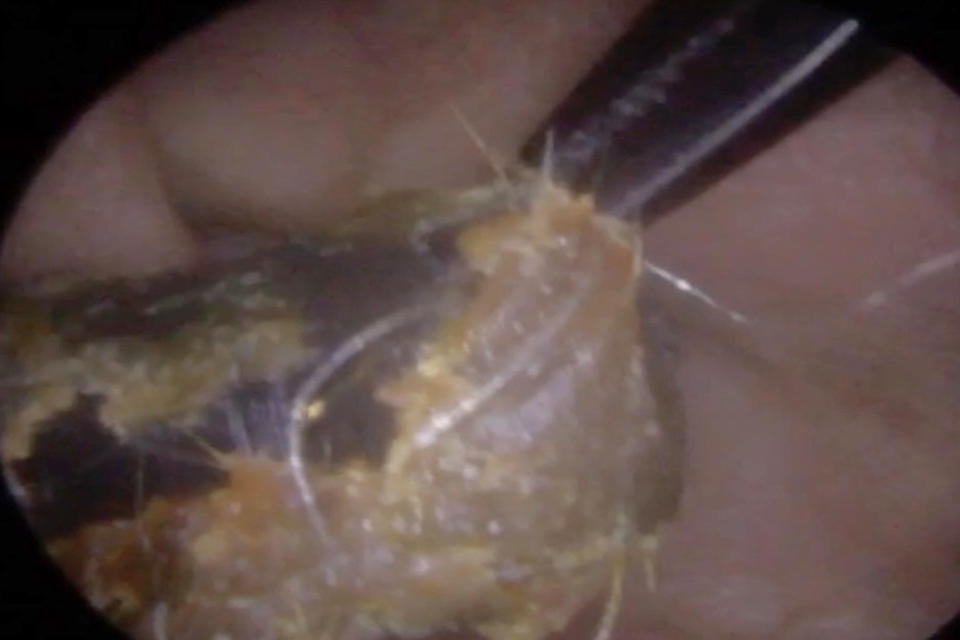 <em>Gross – the video footage shows a pen cap that had been stuck in a man’s ear for years finally being removed (Pictures: Caters)</em>