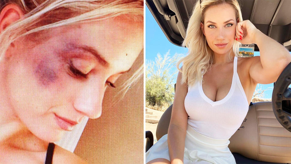 Paige Spiranac, pictured here after being punched by her college roommate.