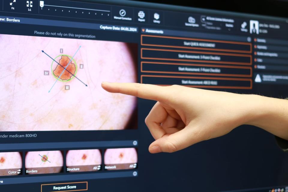 Third-year Dalhousie University medical student Rachel Dorey points at an image of a mole captured by the camera used in the FotoFinder system - an AI-based tool that can be used to detect skin cancers - on January 4, 2024.