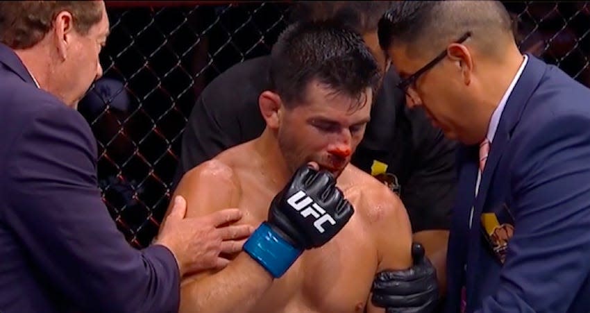 A close-up of Cruz's nose following Vera's head kick.