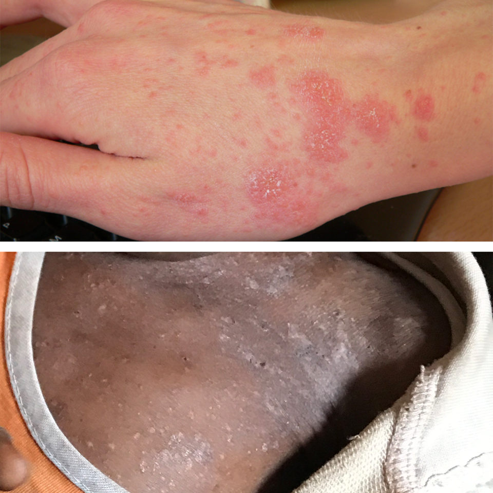 <p><strong>What it looks like:</strong> Scabies is a skin infestation caused by a mite. Untreated, these microscopic mites can live on your skin for months. They reproduce on the surface of your skin and then burrow into it to lay eggs. This causes an itchy, red rash to form on your skin. The extremely itchy rash may be pimply, made up of tiny blisters, or scaly.</p><p><strong>Symptoms to note:</strong> After the initial exposure to scabies, it can take 2 to 5 weeks for symptoms to appear. If you've had scabies before, the symptoms usually develop more quickly, often as soon as 1 to 4 days after exposure. The hallmark symptoms of scabies include a rash and intense itching that gets worse at night. Continuous scratching of the infected area can create sores that can become infected. If this occurs, reach out to your doctor; additional treatment with antibiotics for the skin infection may be needed.</p>