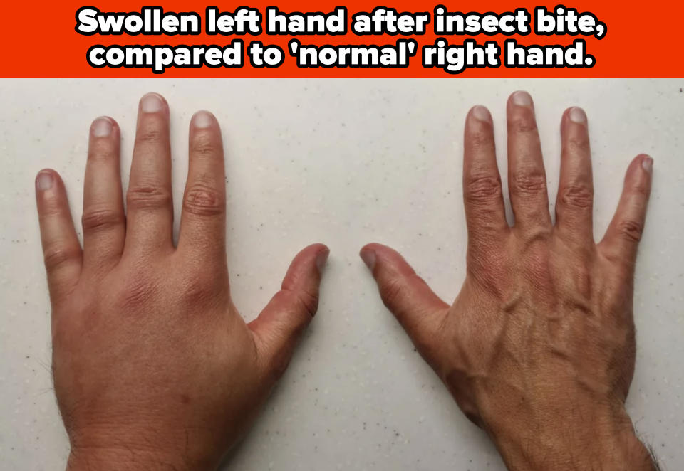 Swollen left hand after insect bite compared to normal right hand