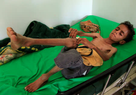 Malnourished Ghazi Ahmad, 10, lies on a bed at a hospital in Taiz, Yemen October 30, 2018. Picture taken October 30, 2018. REUTERS/Anees Mahyoub