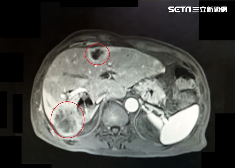 許先生因肝內管癌(下方紅圈處)影響，導致肝膿瘍(上方紅圈處)無法治癒（圖／大千綜合醫院提供）