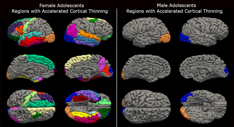 12 different brain drawings showing brain mutations in female and male adolescents (University of Washington's Institute for Learning & Brain Sciences)