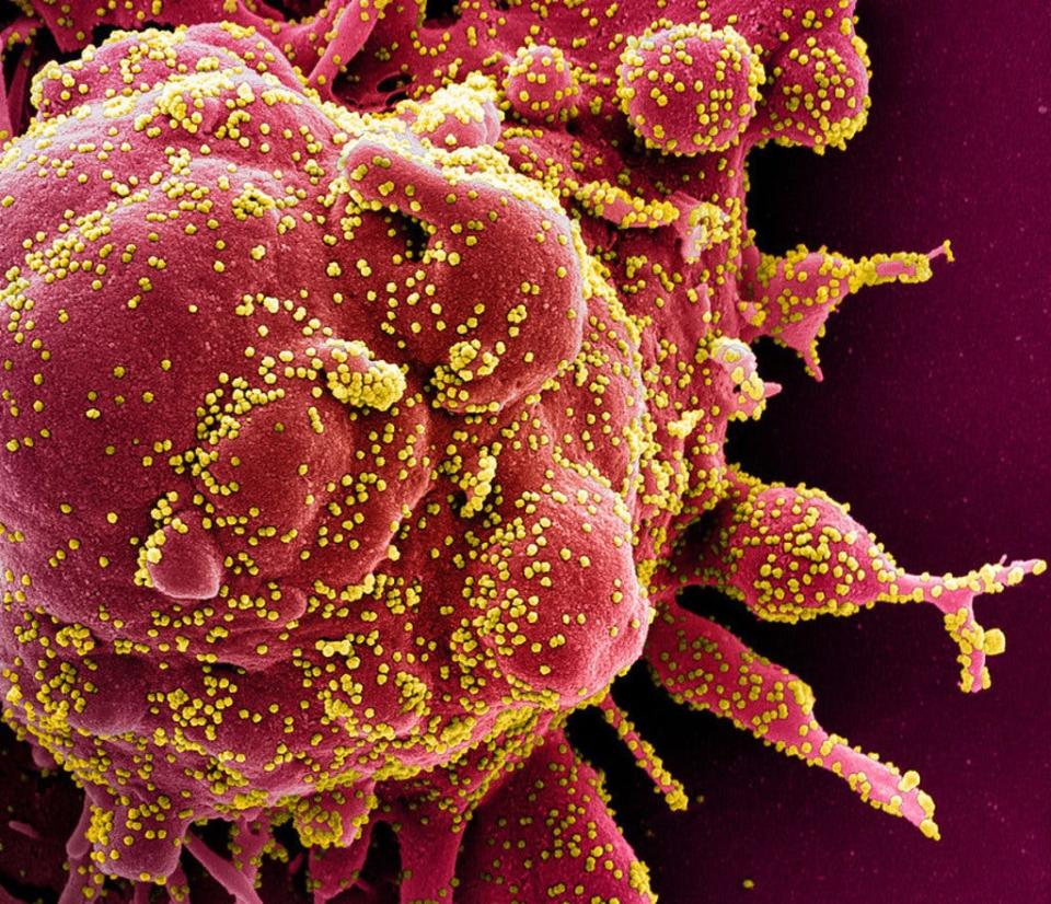 This handout image obtained on April 29, 2020 and released by the National Institute of Allergy and Infectious Diseases (NIAID) of the National Institutes of Health (NIH), shows a colorized scanning electron micrograph of an apoptotic cell (red) heavily infected with SARS-COV-2 virus particles (yellow), isolated from a patient sample captured at the NIAID Integrated Research Facility (IRF) in Fort Detrick, Maryland.