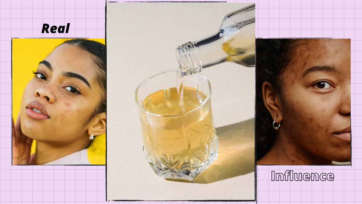  Apple Cider Vinegar for acne: two images of women with acne/ blemishes on the skin alongside a picture of a glass of apple cider vinegar/ in a purple 3-picture template. 