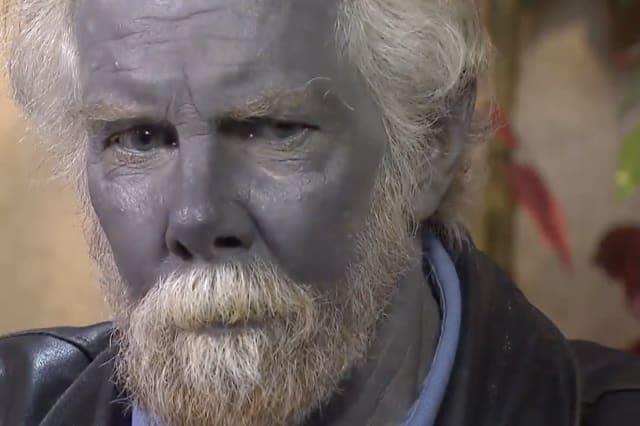 Why this man's skin turned blue