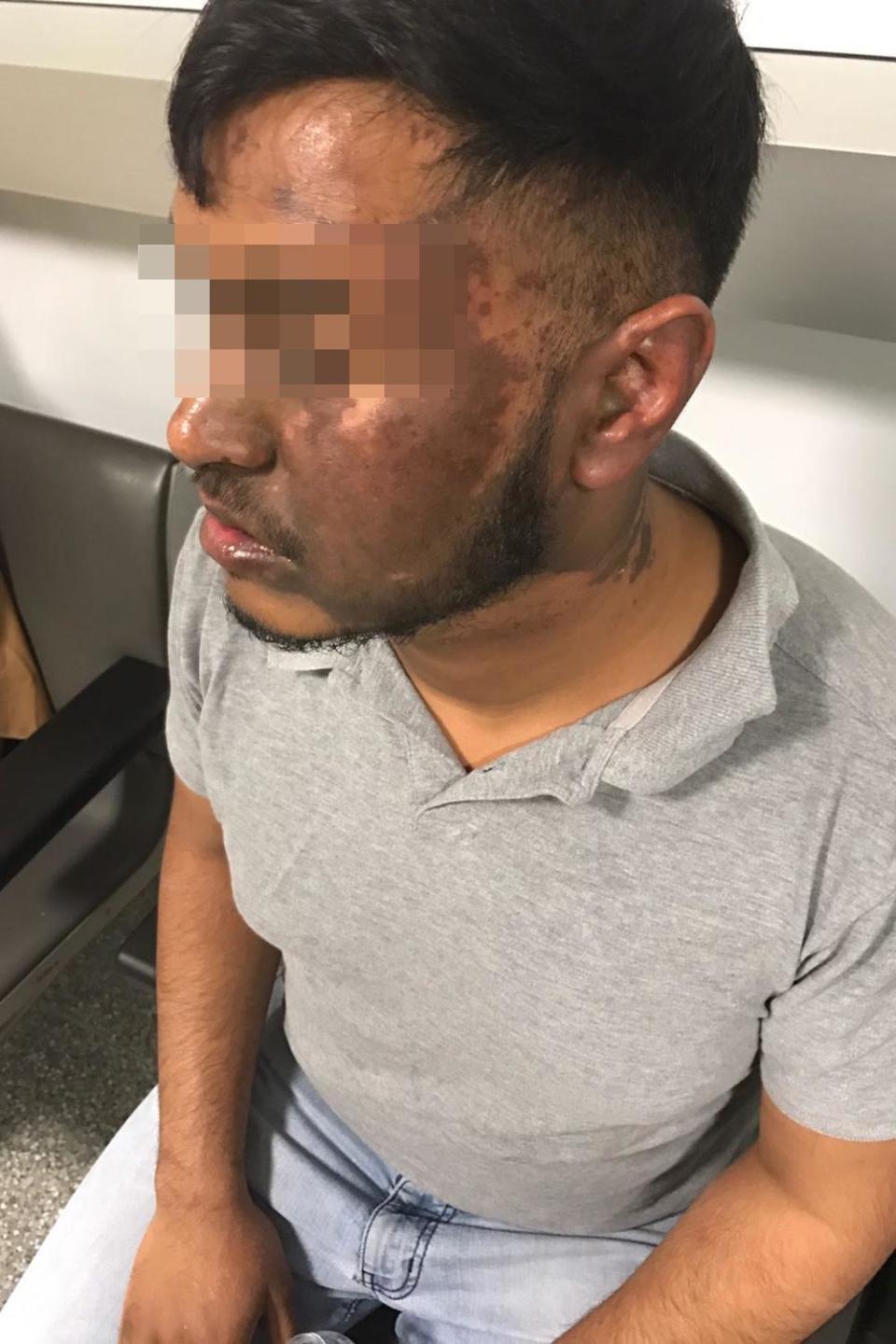 Shakwat Hussain, 24, will have to undergo skin grafts after the attack