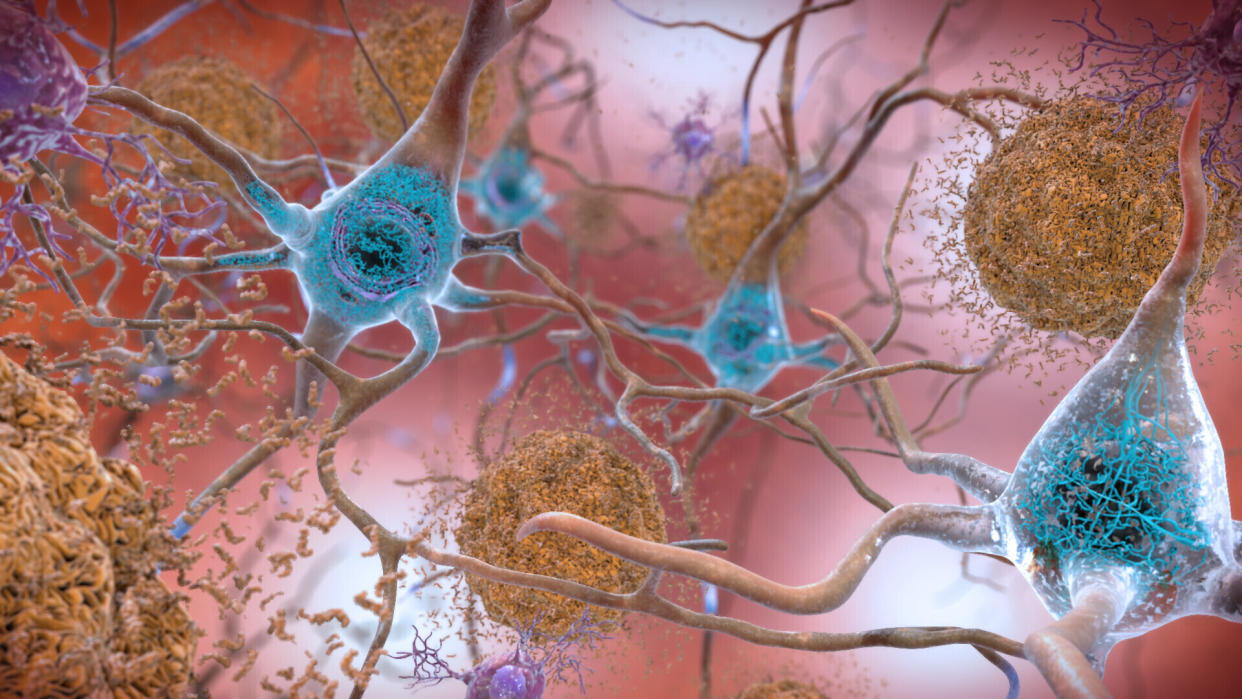 This illustration made available by the National Institute on Aging/National Institutes of Health depicts cells in an Alzheimer’s affected brain, with abnormal levels of the beta-amyloid protein clumping together to form plaques, brown, that collect between neurons and disrupt cell function. Abnormal collections of the tau protein accumulate and form tangles, blue, within neurons, harming synaptic communication between nerve cells. An experimental Alzheimer’s drug modestly slowed the brain disease’s inevitable worsening, researchers reported Tuesday, Nov. 29, 2022 - and the next question is how much difference that might make in people’s lives. Japanese drugmaker Eisai and its U.S. partner Biogen had announced earlier this fall that the drug lecanemab appeared to work, a badly needed bright spot after repeated disappointments in the quest for better Alzheimer’s treatments. (National Institute on Aging, NIH via AP)