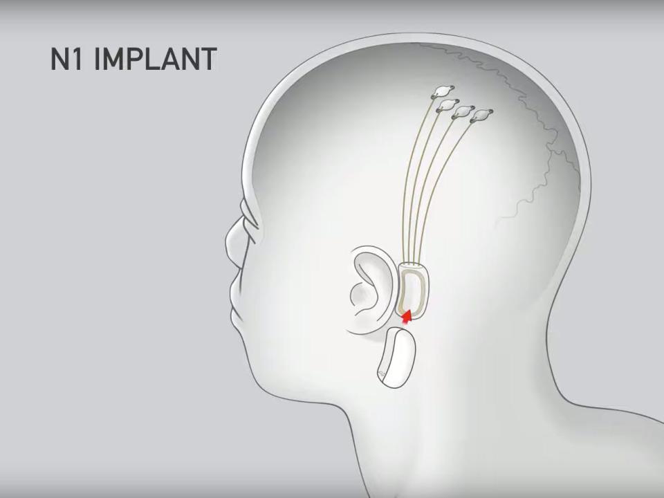 Neuralink chip