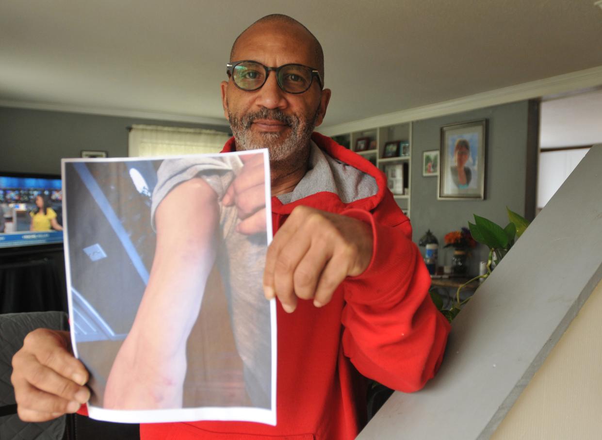 Gerald Lopes holds a photo on Monday in Dennis of his arm with the marks he said were caused when he was arrested while working as a custodian at Barnstable High School in Hyannis. Lopes said he was forced to retire after being arrested at the school.
