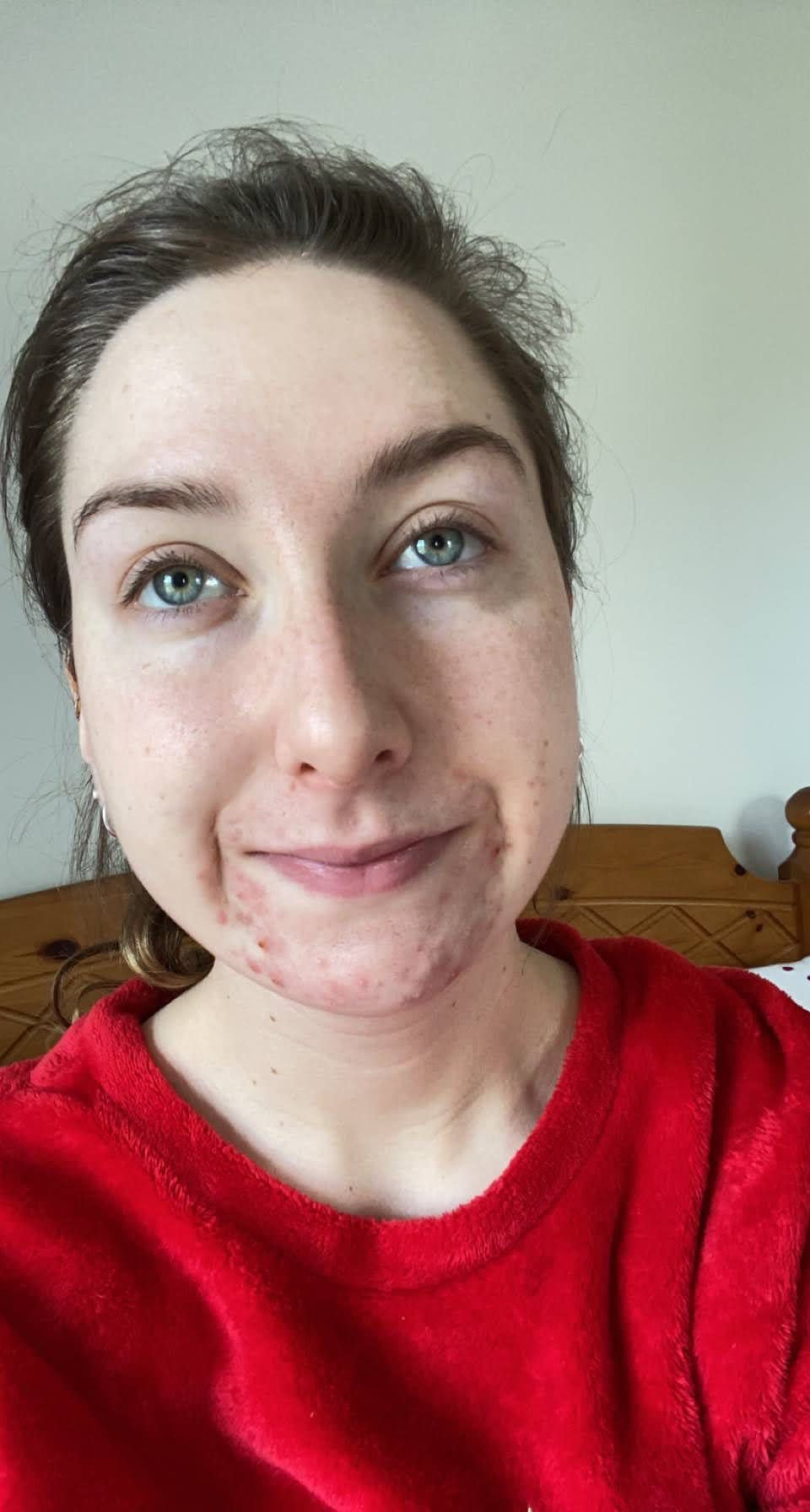 Kate found a solution for her acne using data and artificial intelligence