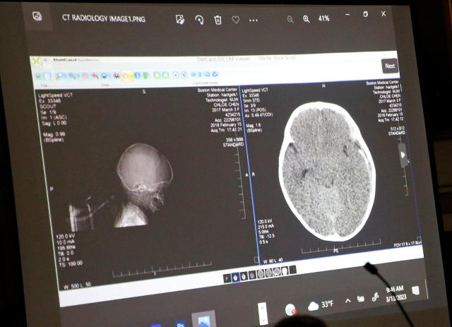 Scans of 11-month-old Chloe Chen's brain injuries are displayed by the prosecution Monday, March 13, 2023.