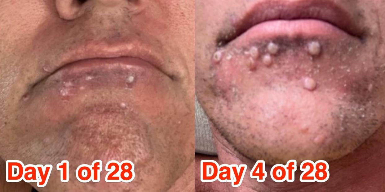 Side by side pictures of Silver Steele's lesions are shown at day 1 and day 4