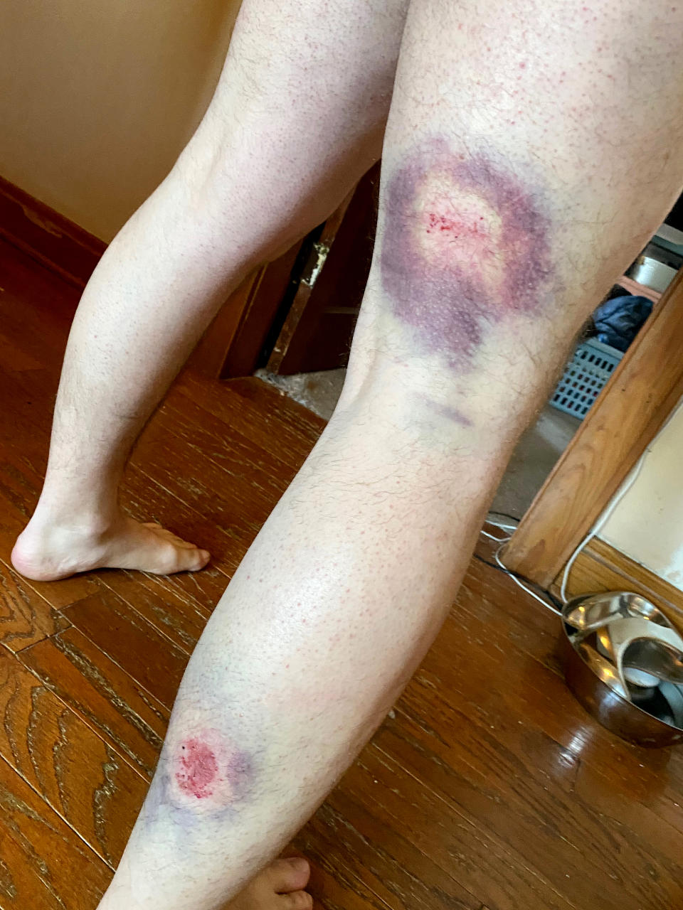 IMAGE: Nathan Caraway's leg (Nathan Caraway)