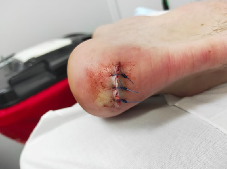 Mr Madigan required several stitches and needed crutches for several days. Source: Supplied/ Jordan Madigan